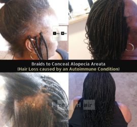 Braids to Conceal Alopecia Areata (Hair Loss caused by an Autoimmune Condition)