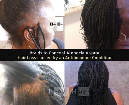 Braids to Conceal Alopecia Areata (Hair Loss caused by an Autoimmune Condition)