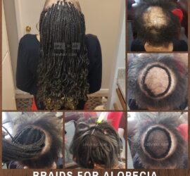 Braids for Alopecia