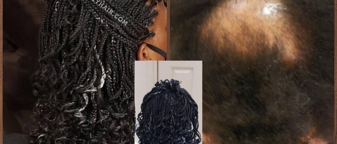 Black and White Individual Braids to Conceal Alopecia Areata
