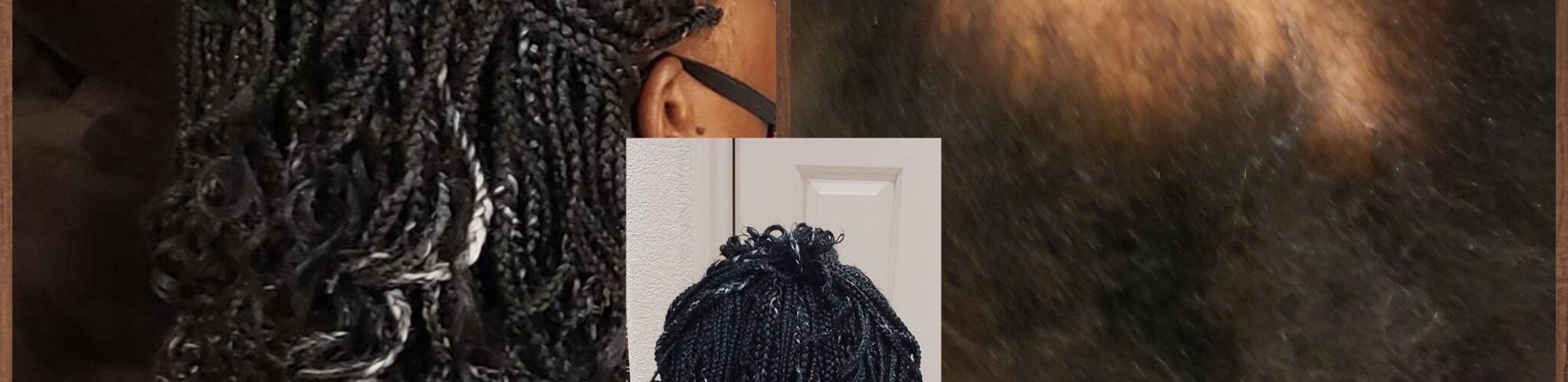 Black and White Individual Braids to Conceal Alopecia Areata