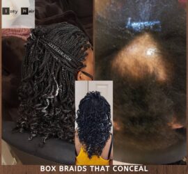 Black and White Individual Braids to Conceal Alopecia Areata
