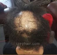 Braids for Alopecia - Izey Hair