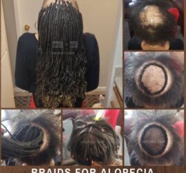 Alopecia Box Braids