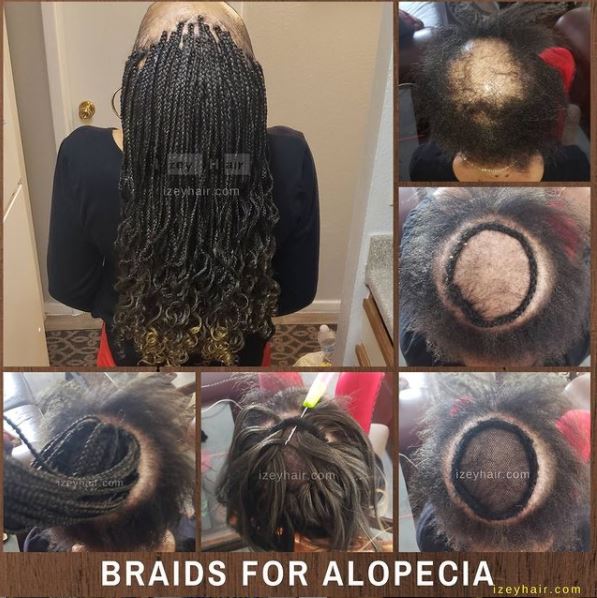Alopecia Box Braids