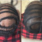 Breathable Net for Alopecia