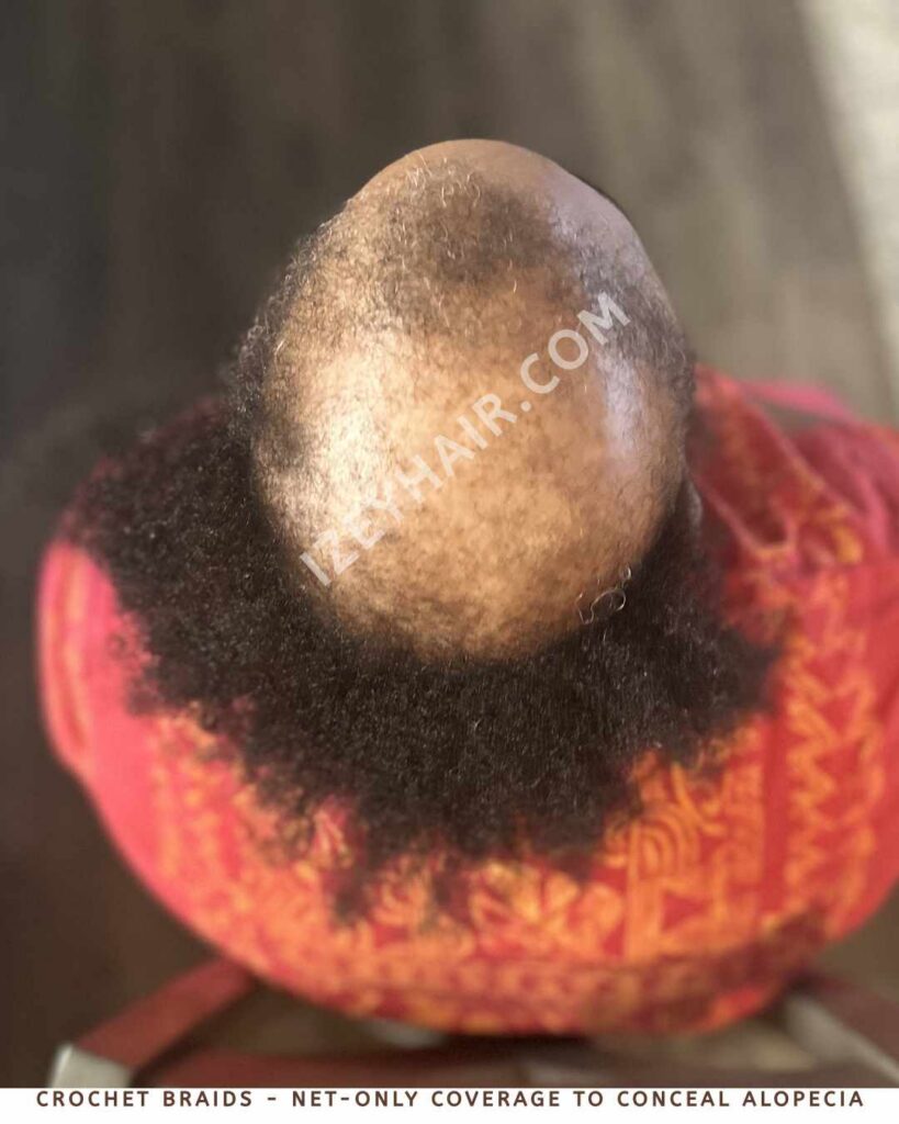 Crochet Braids - Net-Only Coverage to Conceal Alopecia