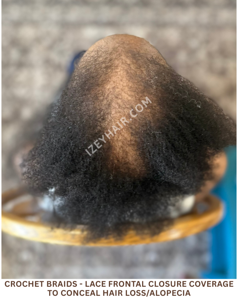 Crochet Braids - LACE FRONTAL CLOSURE coverage to conceal HAIR LOSS Alopecia