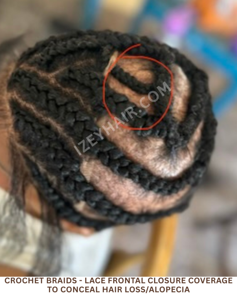  Crochet Braids - LACE FRONTAL CLOSURE coverage to conceal HAIR LOSS Alopecia